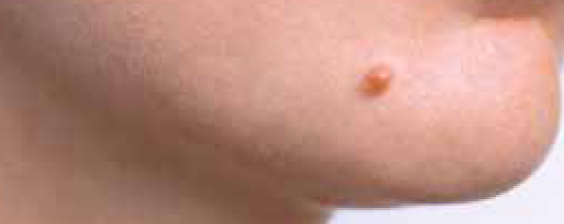 Nevus