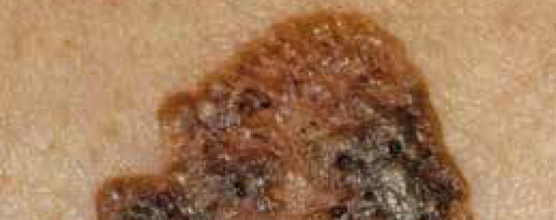 Queratosis seborreicas