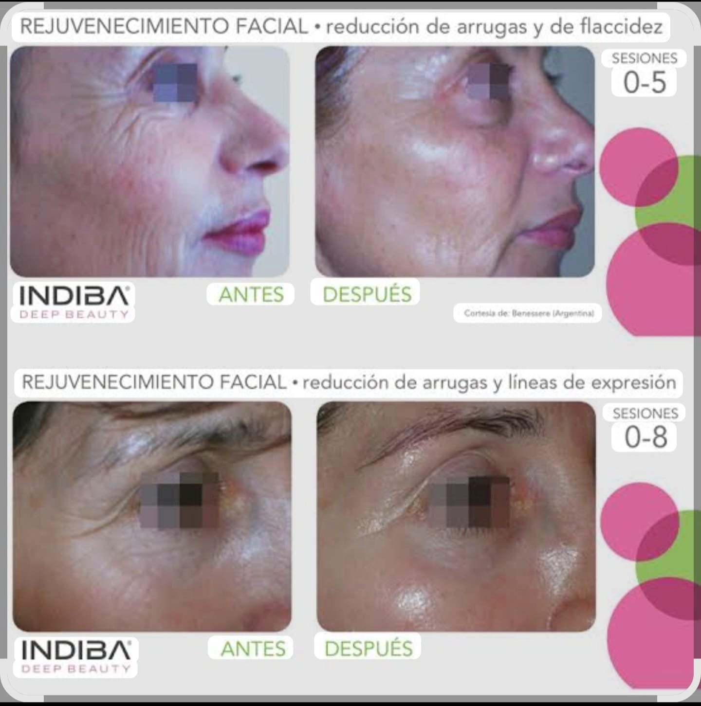 Cheque regalo de tratamiento facial Indiba