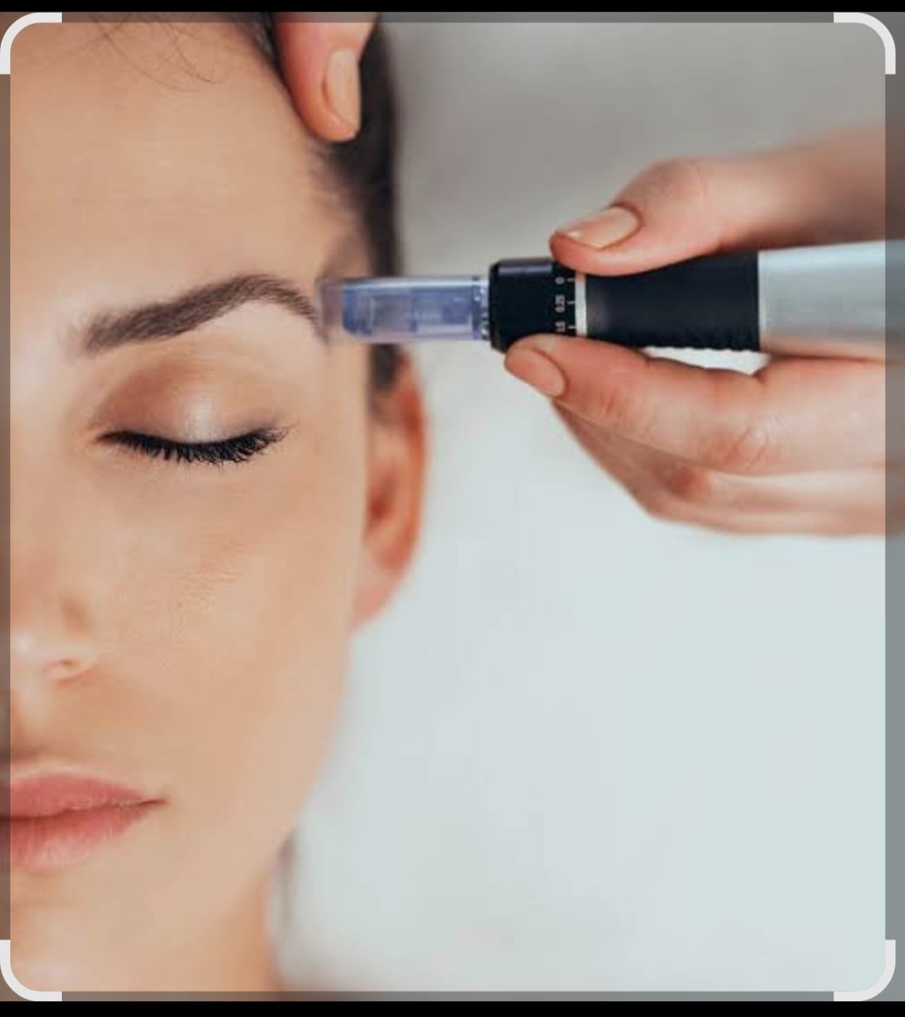 Cheque regalo tratamiento facial dermapen