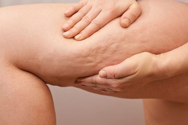 CinfaSalud-celulitis-600-1200x900